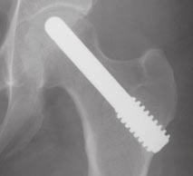 The high coefficient of friction and ingrowth potential of Trabecular Metal Material facilitates early implant fixation and stability.