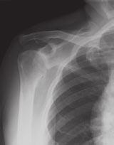 For the shoulder surgeon who prefers a porous fixation option with the potential for immediate stability and long-term fixation, the Trabecular Metal Humeral Stem and Trabecular Metal Reverse