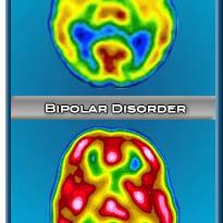 Bipolar Affective Disorder Bipolar affective diseases are divided into various types according to the symptoms displayed.