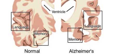 of memory. Alzheimer s disease is coded to category G30. (1) G30.9 Alzheimer s disease [without any mention of dementia] G30.1 + F02.