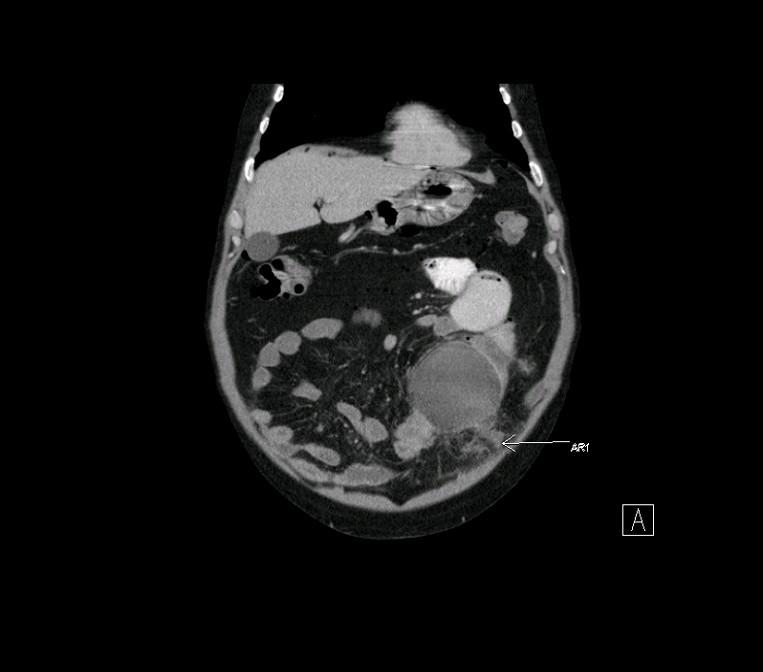 Figure 1: Coronal CT image of mesenteric