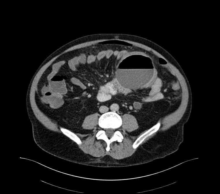 Figure 2: Axial CT image of mesenteric abscess