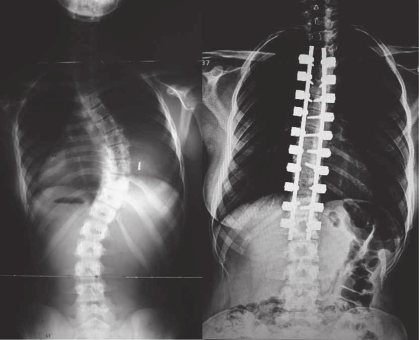 lenke i adolescent idiopathic scoliosis 489 Fig. 2. Preoperative and 3 year postoperative x-ray of a patient in bilateral fixation group Patients without standard X ray were excluded from the study.