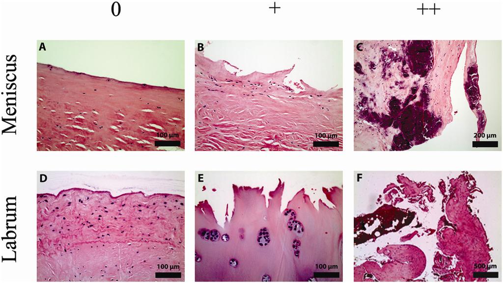 Zhang et al. 167 Figure 1. Representative micrographs showing the degeneration of the menisci and labra graded 0, +, and ++.