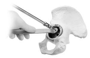 Trilogy Acetabular System 5 Screw Insertion If screw placement is desired, drill a pilot