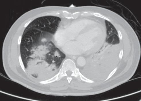 Weinacker A Figure 2: CT of chest axial section reveals bilateral confl uent ground-glass appearance.