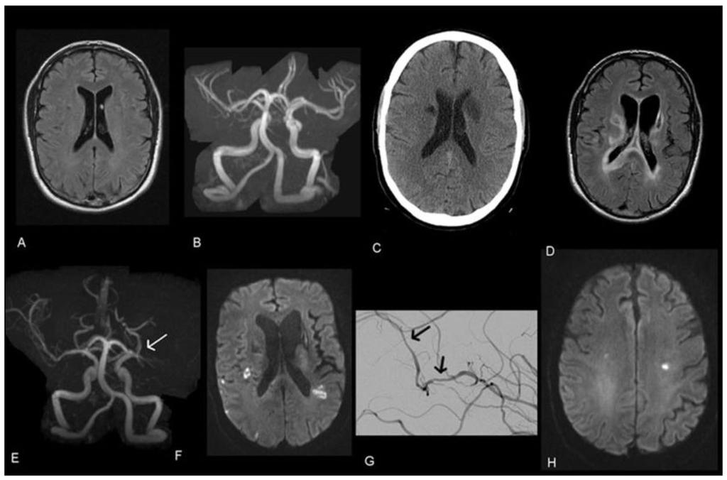 Silver et al. Page 6 Fig. 1. In February 2010, brain MRI (FLAIR sequence) (A) and brain MRA (B) were normal.