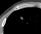 years radiation concerns: from screening LDCT exams serial CT used as the