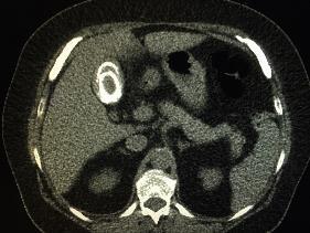 pulmonary nodules 2.