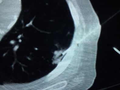 PET-CT showed Stage IA cancer; No