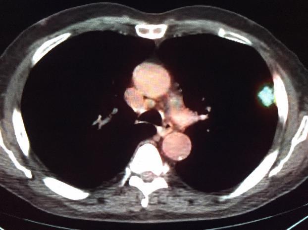 distant metastases CT guided biopsy