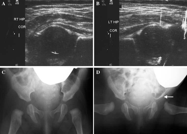 J Child Orthop (2010) 4:3 8 5 Fig. 2 Case example #2. First-born female, breech position, with normal ultrasound (a, b) at age 6 weeks with symmetric clinical abduction of 75.