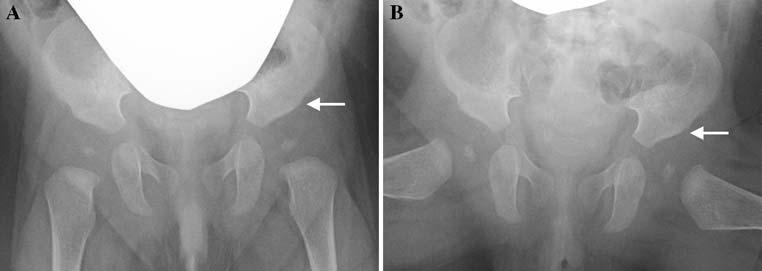 6 J Child Orthop (2010) 4:3 8 Fig. 4 Example of abnormal X-ray AP (a) and frog pelvis (b). Note the rounded corners, especially on the left (see arrow).