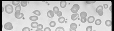 Aniso, poik Platelets= 670,000 mm3 Reactive or clonal? Evidence of previous elevation? Splenomegaly?