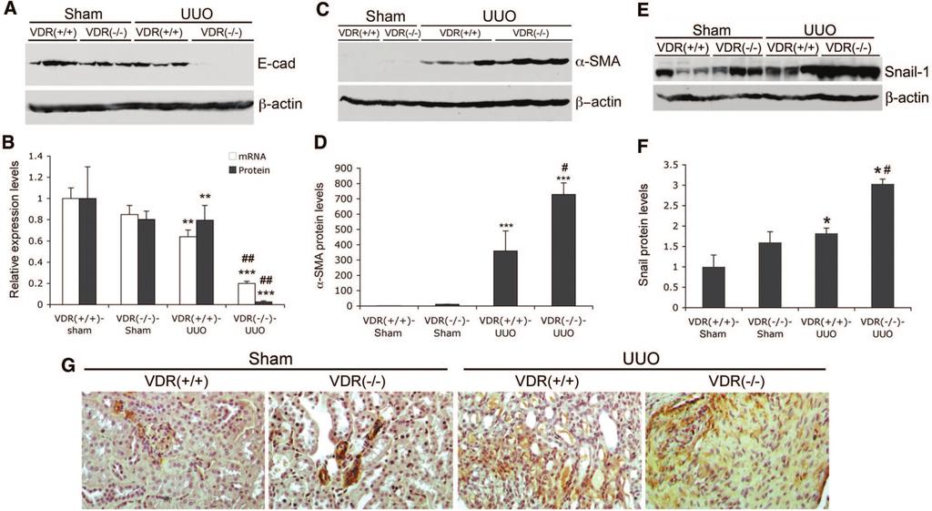 www.jasn.org BASIC RESEARCH Figure 4. VDR ablation promotes EMT. (A) Western blot analysis of E-cadherin (E-cad) in sham-operated and obstructed kidneys from VDR( / ) and VDR( / ) mice.