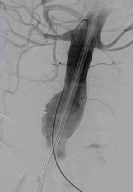 renal artery (RA)