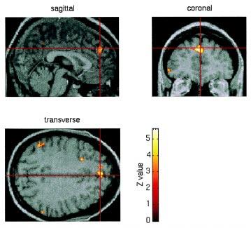 20 H.L. Gallagher et al. / Neuropsychologia 38 (2000) 11±21 Fig. 4. Area of activation in the medial frontal cortex of a single subject elicited by theory of mind stories and cartoons.