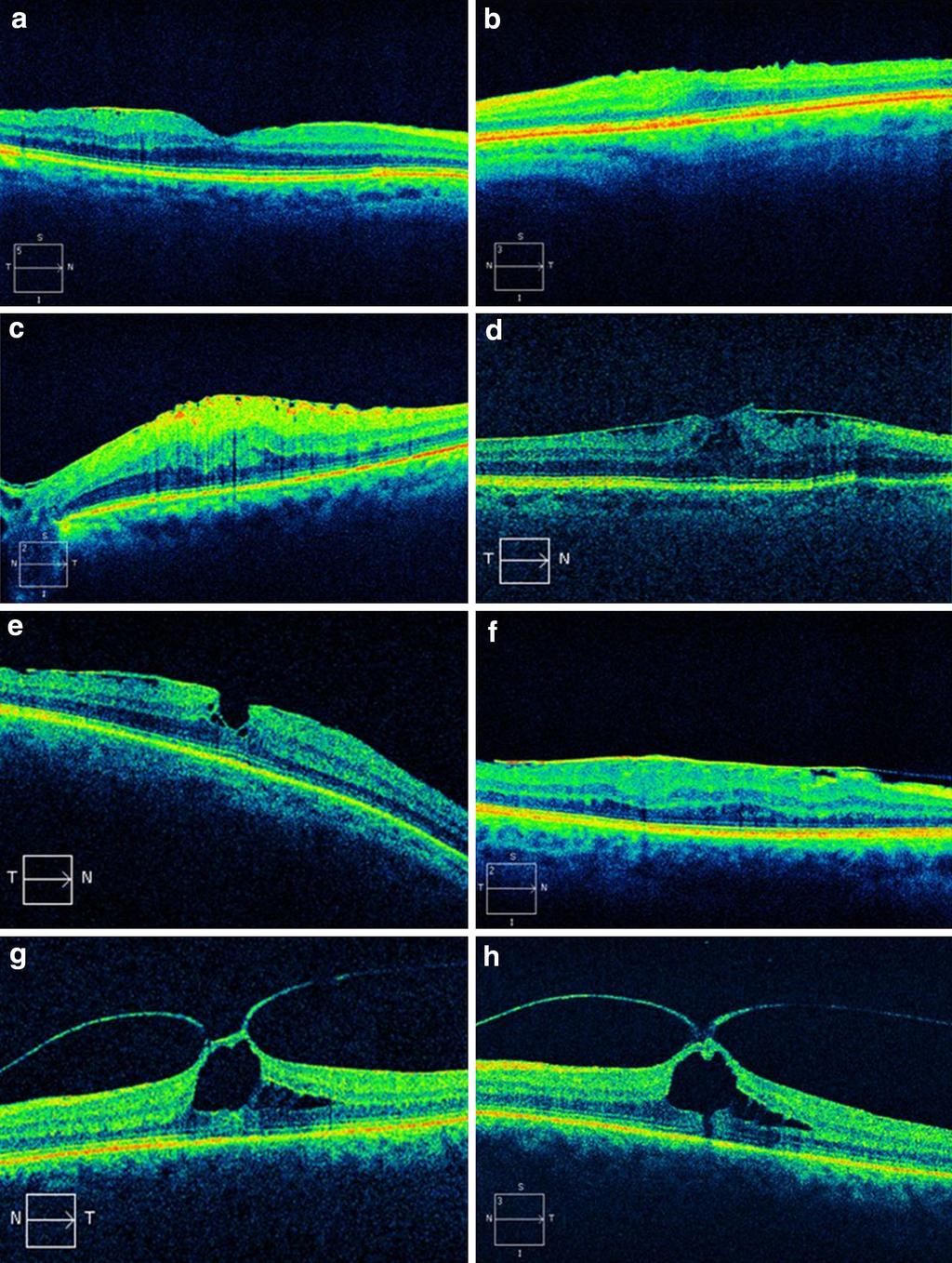 Fig. 2 Epiretinal membranes with posterior vitreous detachment without contraction (a), with folding (b), with edema (c), with cystoid macular edema (d), and