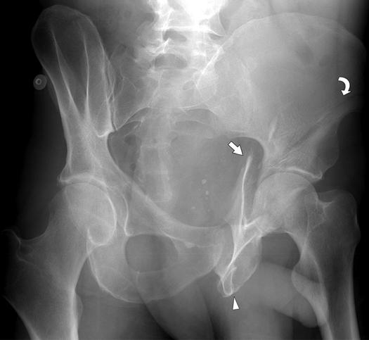 4 45-year-old man with both-column acetabular fracture.