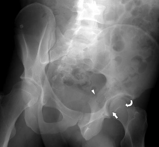 , nteroposterior pelvic radiograph (), bilateral