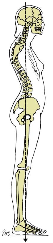 pelvis in posterior tilt Sway back A long outward curve of the thoracic