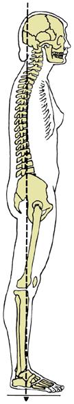 anterior lumbar curve Sway back: decreased anterior lumbar curve and