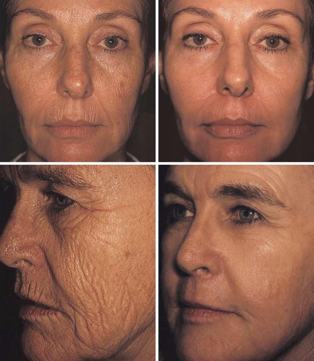 A B C D Figure 1. A and C, Photographs representing the skin of 2 of our patients before full-face laser resurfacing using our supplemented topical anesthesia protocol.