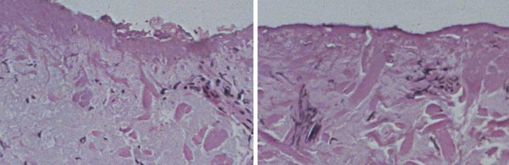 A B Figure 2. Histologic photographs of skin treated with carbon dioxide laser.