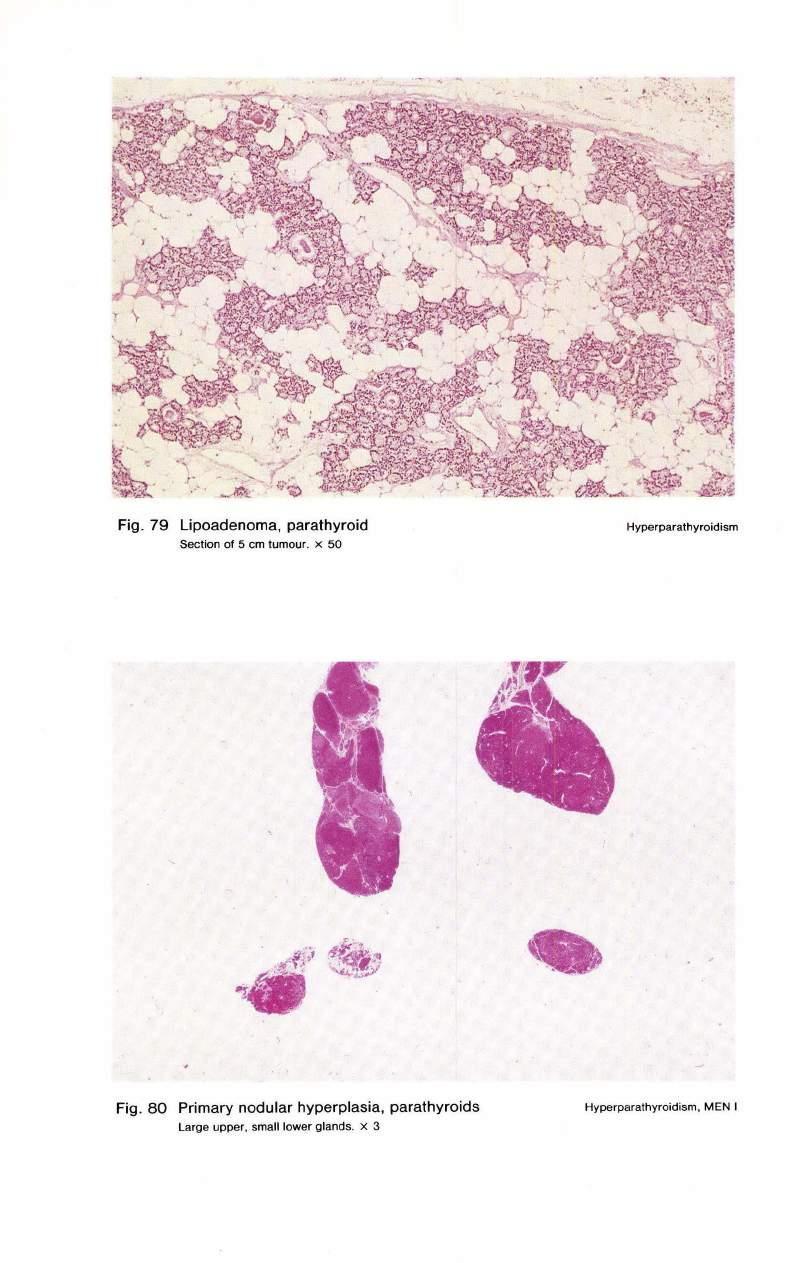 ~ '-. ''. -;_;>'- ~ -. ~ \~ Fig. 79 Lipoadenoma, parathyroid Section of 5 cm tumour.