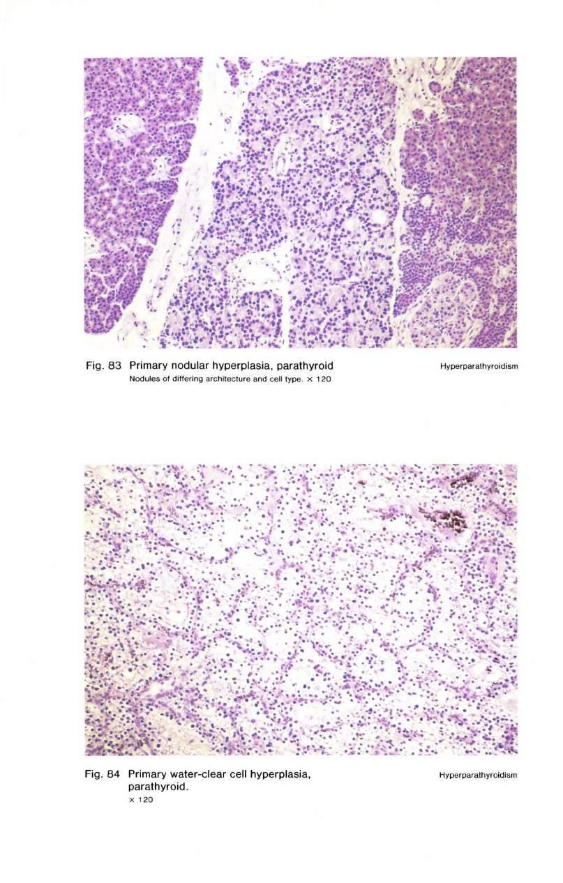 Fig. 83 Primary nodular hyperplasia, parathyroid Nodules of differing architecture and cell type. X 120 Hyperparathyroidism : ~... ~.... :...,..,... --,... :. k..,....,,.,,...,.... ~. :-., J..~.. ~-; :.