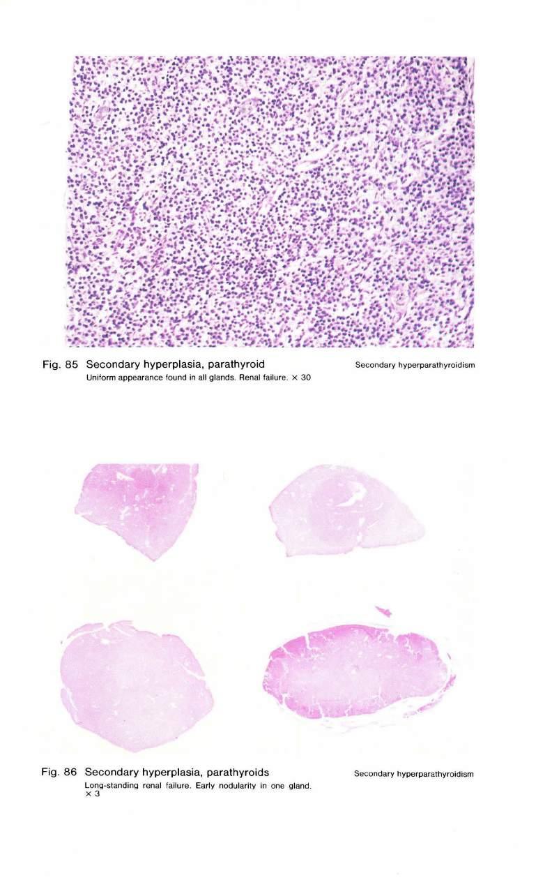 Fig. 85 Secondary hyperplasia, parathyroid Uniform appearance found in all glands. Renal failure.