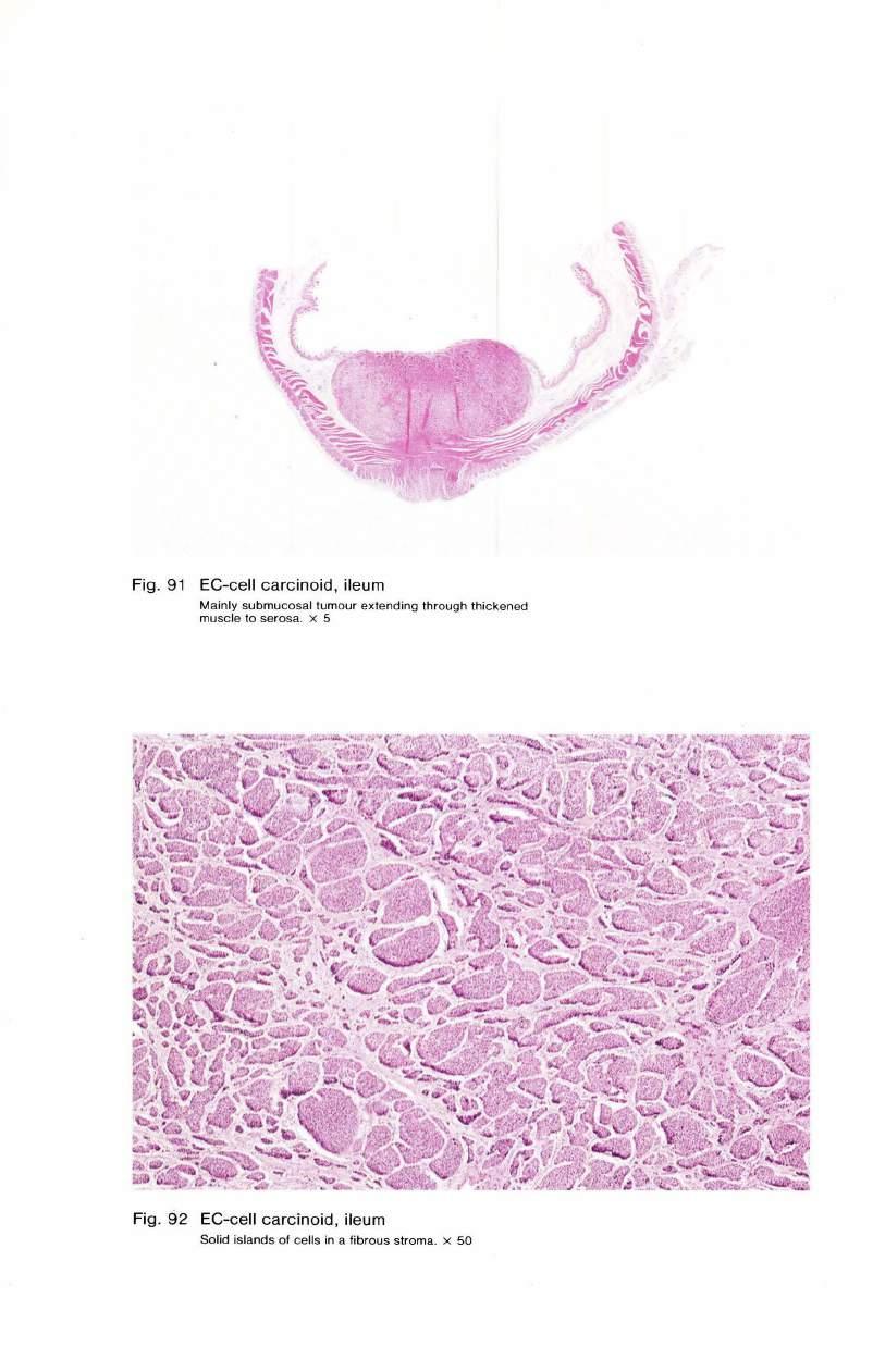 Fig. 91 EC-cell carcinoid, ileum Mainly submucosal tumour extending through thickened muscle