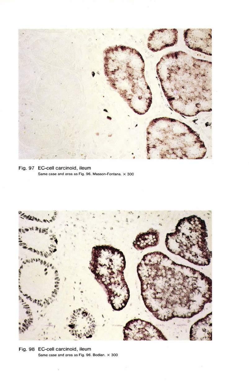Fig. 97 EC-cell carcinoid, ileum Same case and area as Fig. 96. Masson-Fontana. X 300 \.
