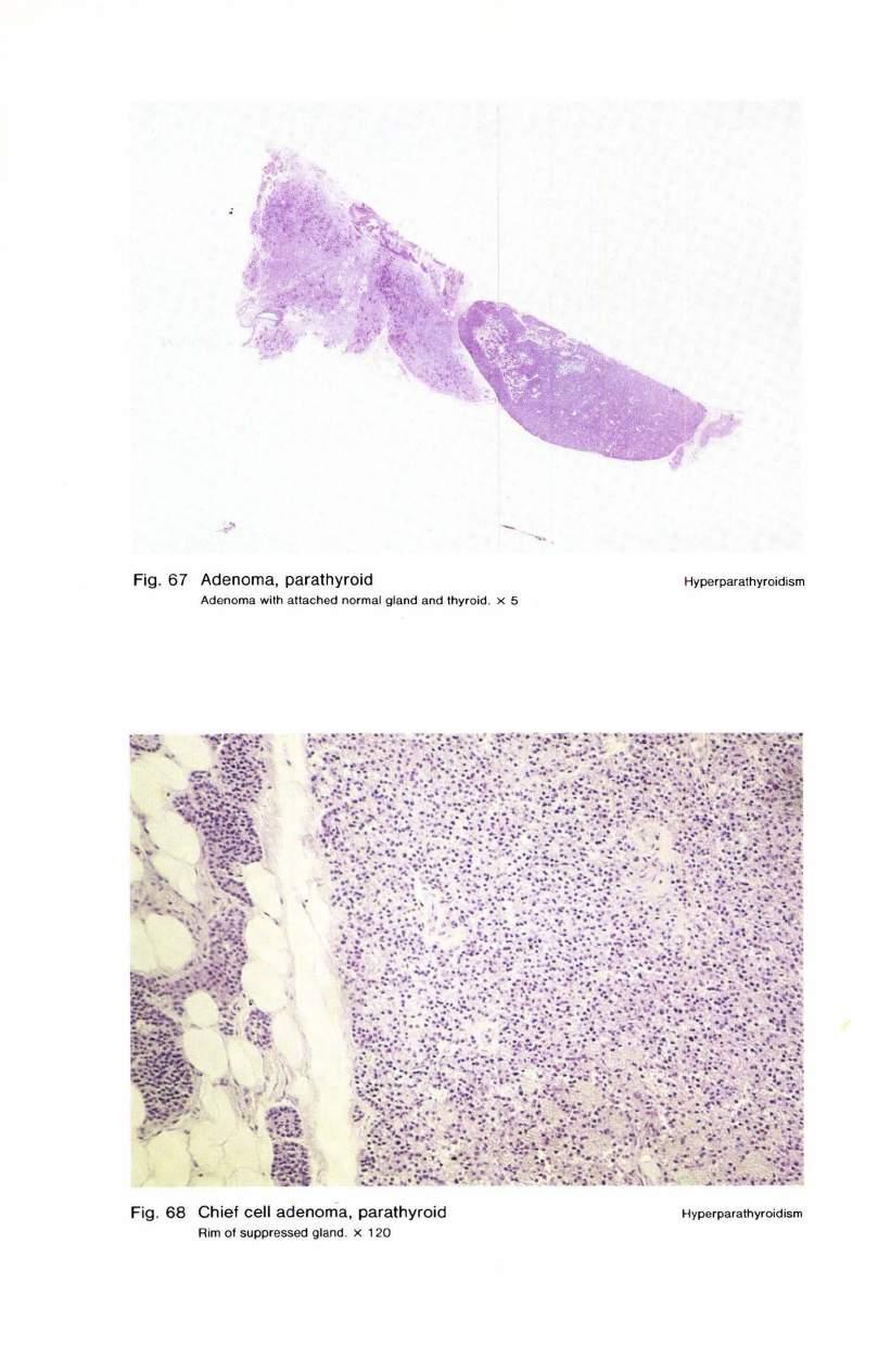Fig. 67 Adenoma, parathyroid Adenoma with attached normal gland and thyroid. x 5 Hyperparathyroidism.,.,, ~""' :~.