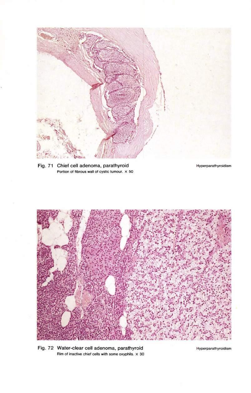 Fig. 71 Chief cell adenoma, parathyroid Portion of fibrous wall of cystic tumour. x 50 Hyperparathyroidism Fig.