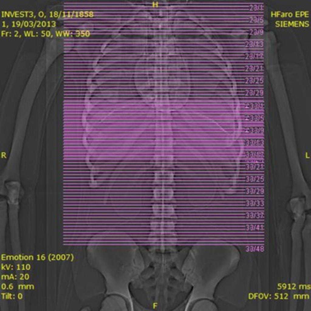 Fig. 7: Topogram of routine abdomen CT