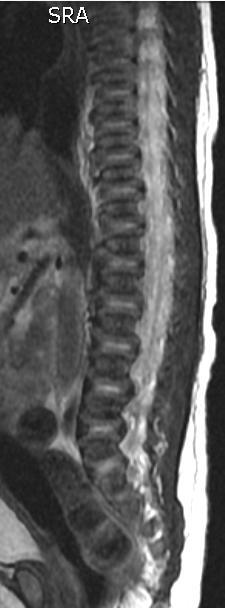 Ossified vertebra Disk Vertebra