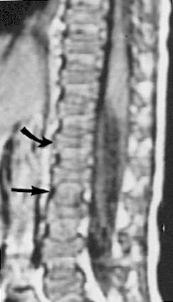 Normal Pediatric Spine Stage