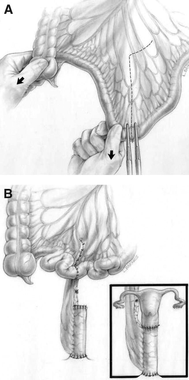 Therefore, one has to enter the abdomen just to identify the rectum and pull it down. This unique type of case might be ideal for laparoscopy.