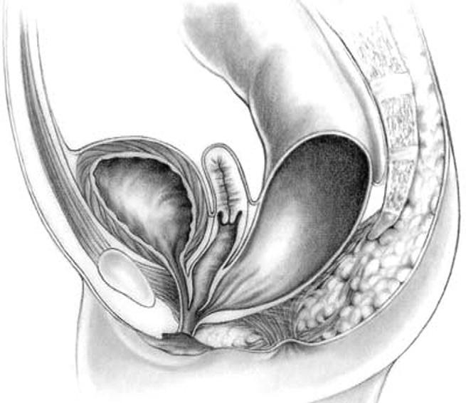 Before 1996, the vagina was separated from the urinary tract, 6 which was a technically demanding maneuver, took many hours, and led to a significant number of urethrovaginal fistulas because of that