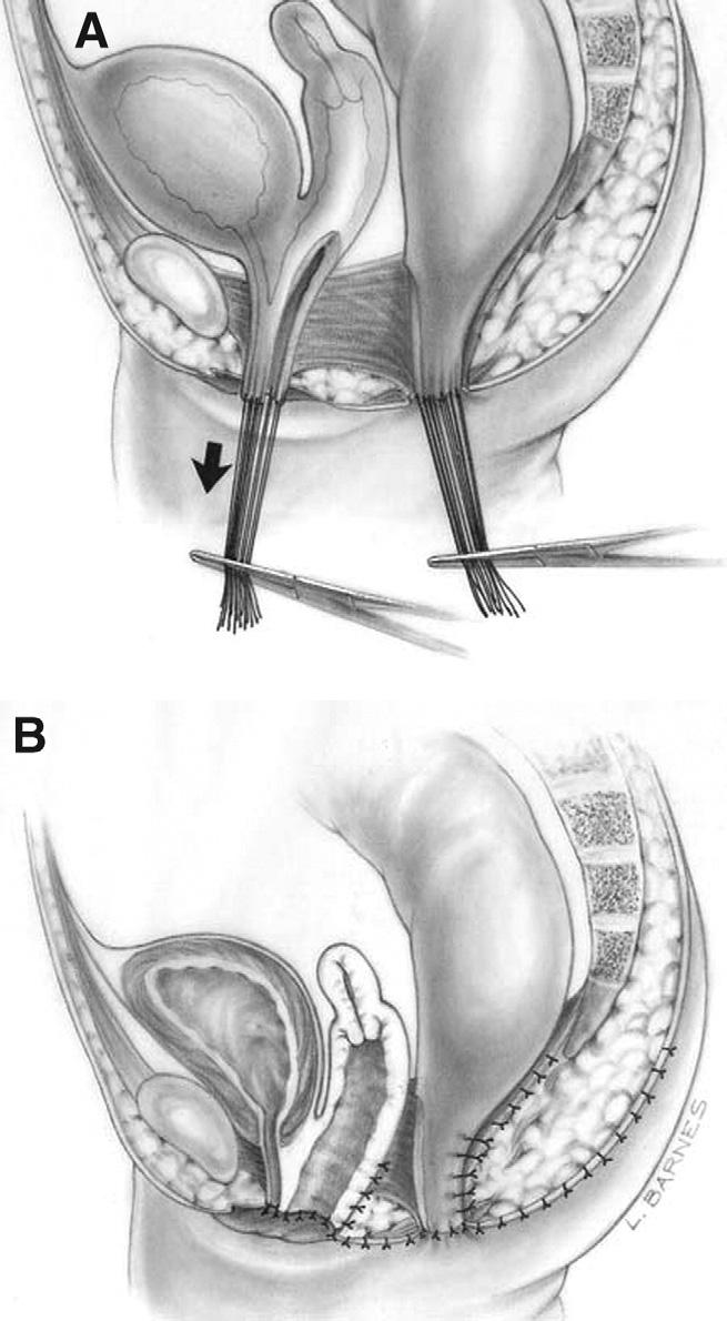 0 silk sutures in the edges of the common channel and the lateral walls of the vagina to apply Figure 6 (A, B) Total urogenital mobilization. (Reprinted with permission.