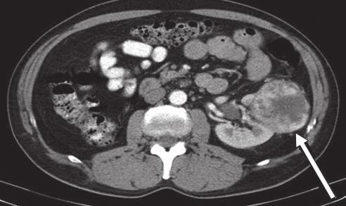 Nephrometry Score Fig. 10 61-year-old man with high-complexity left clear cell carcinoma (arrow). Nephrometry score is 2 + 2 + 3 + a + 3 = 10a. 13. Simmons MN, Ching CB, Samplaski MK, et al.