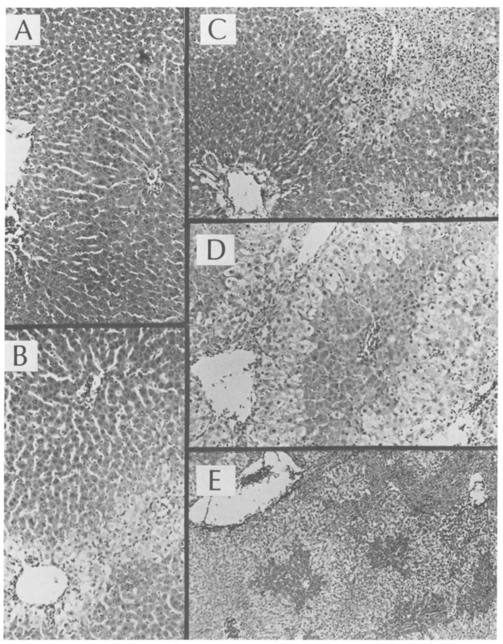 Grade 1 +: early ballooning and eosinophilic degeneration of cytoplasm in centrilobular hepatocytes (x 1). C.
