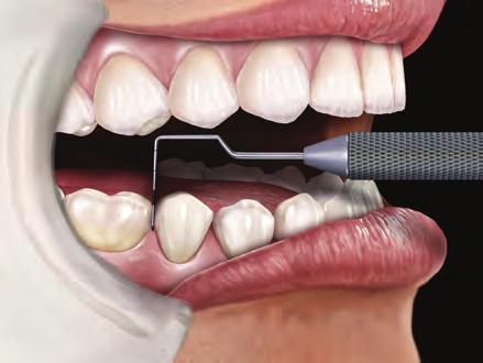 novatech RESToRATIve instrument innovations Probes The Novatech periodontal probes can measure pocket depth very accurately due to their ergonomic design.