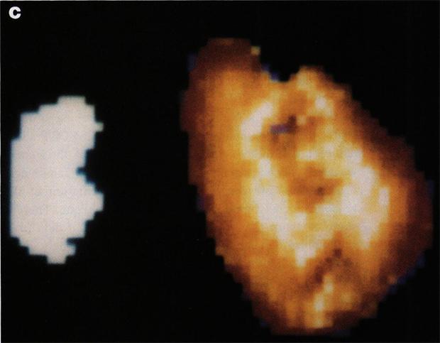 These defects were reported as defects in all three patients using three-view display but in only one with the three-dimensional display.