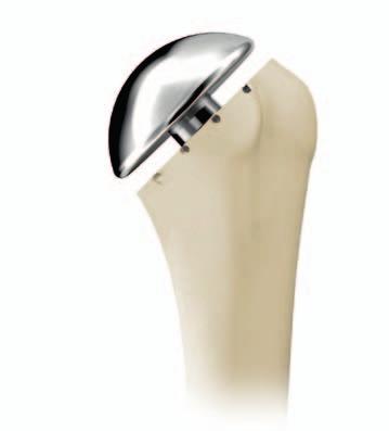 24 Sidus Stem-Free Shoulder Surgical Technique 4. Head Preparation and Implantation Place the Trial Head on the Humeral Anchor and conduct the trial reduction (Fig. 35).