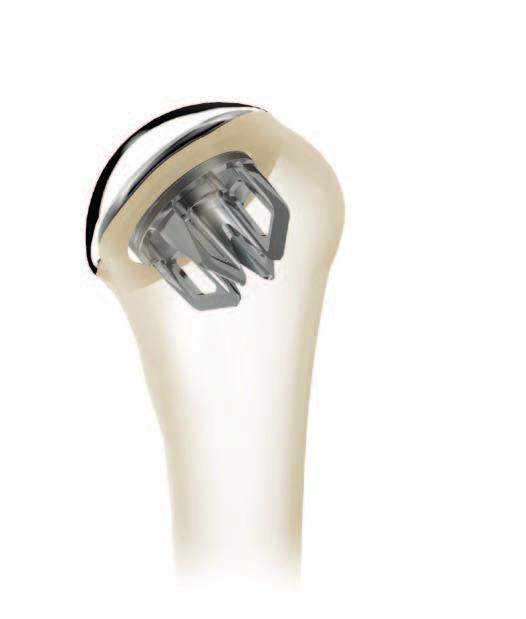 The Sidus Stem-Free Shoulder Humeral Anchor, by virtue of its minimal profile, enables future options for revision or upgrade to an inverse/ reverse solution, while also eliminating the potential for