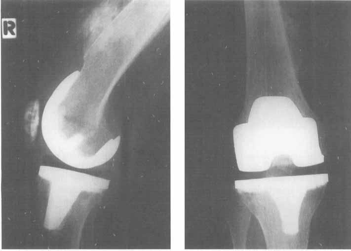 48 Acfa Orthop Scand 1997; 68 (1): 46-50 Figure 2. A 77-year-old woman with HO grade 111 one year after implantation.