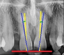 Fig. 1 Determination of the crown-root angulation: we draw the reference plane (red line), the crown axis (yellow line) and the root axis (blue line) Some of the most representative cases with