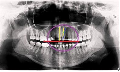 The ortopantomography of a 28-year old orthodontic patient, with permanent dentition (Fig.